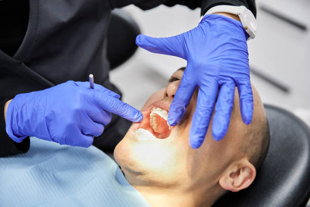 Best Emergency Wisdom Teeth Removal in Novato, CA